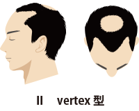 Ⅱ Vertex型