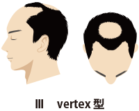 Ⅲ Vertex型
