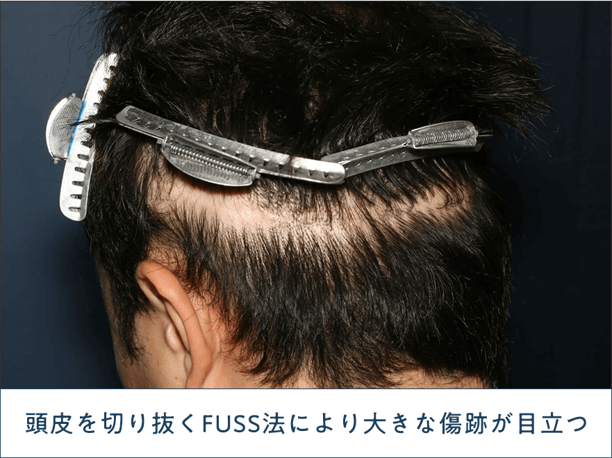FUSS法の傷跡が目立つ植毛の失敗例