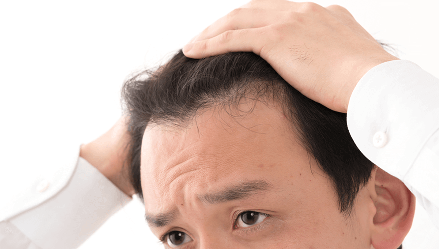 【生え際の後退】その原因と薄毛を改善する画期的な治療法とは？