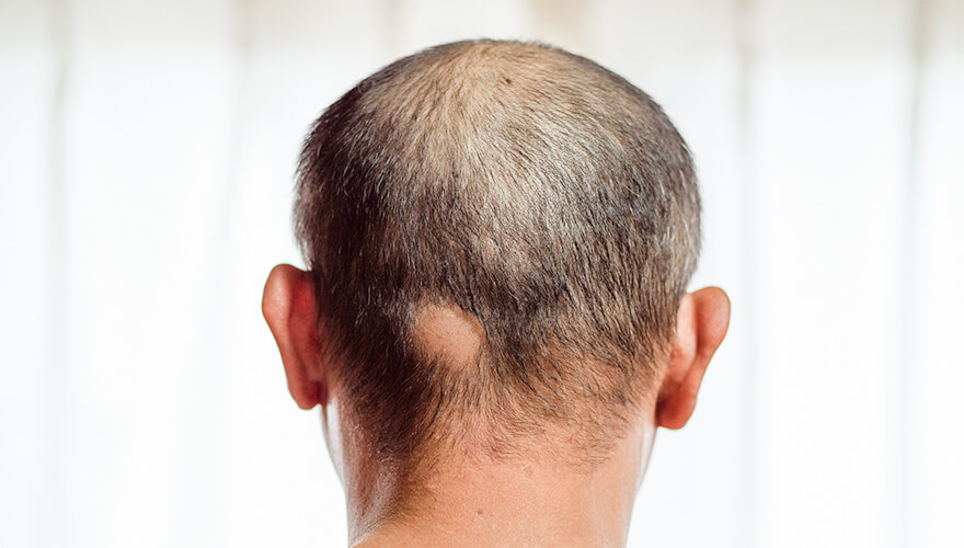 前頭線維化性脱毛症の症状は何ですか?