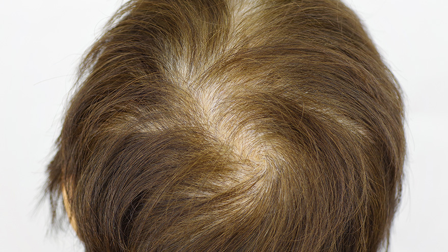 FAGA（女性男性型脱毛症）