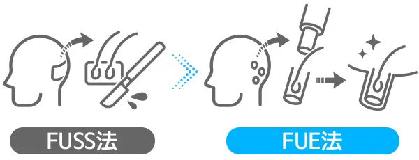 FUSS法に代わって登場したFUE法