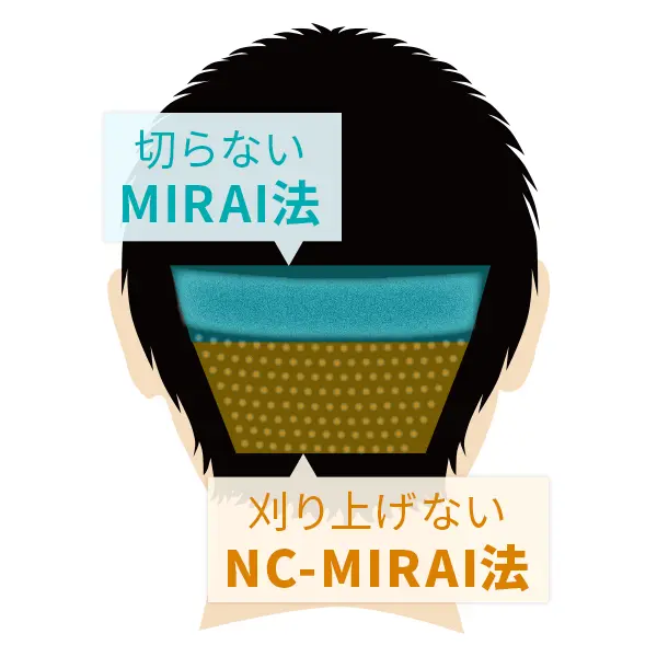 2つの術式を融合した自毛植毛United MIRAI法