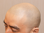 40代男性K.Tさんの頭部写真1（施術前）