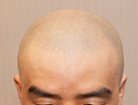 40代男性K.Tさんの頭部写真2（施術前）