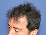 40代男性K.Tさんの頭部写真1（術後5ヶ月）