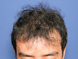40代男性K.Tさんの頭部写真2（術後5ヶ月）