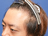 男性M.Yさんの頭部写真1（施術前）