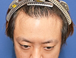 男性M.Yさんの頭部写真2（施術前）