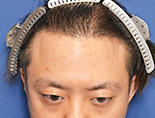 男性M.Yさんの頭部写真2（術後5ヶ月）