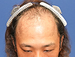 男性O.Sさんの頭部写真2（施術前）