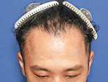 男性O.Sさんの頭部写真2（施術後）