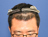 男性T.Hさんの頭部写真2（施術前）