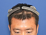 男性T.Hさんの頭部写真2（施術後）