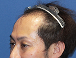 男性K.Y.さんの頭部写真1（施術前）