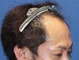 男性K.Y.さんの頭部写真3（施術前）