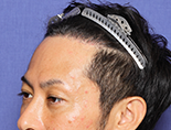 男性K.Y.さんの頭部写真1（施術後）