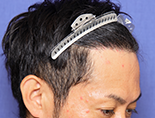 男性K.Y.さんの頭部写真3（施術後）