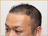 30代 男性 S.Jさんの頭部写真1（施術前）