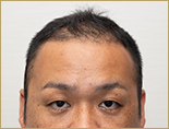 30代 男性 S.Jさんの頭部写真2（施術前）