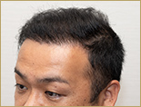 30代 男性 S.Jさんの頭部写真1（施術後）