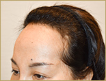 50代 女性 M.Mさんの頭部写真1（施術前）