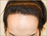 50代 女性 M.Mさんの頭部写真2（施術前）