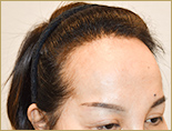 50代 女性 M.Mさんの頭部写真3（施術前）