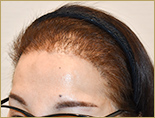50代 女性 M.Mさんの頭部写真1（施術後）