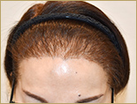 50代 女性 M.Mさんの頭部写真2（施術後）