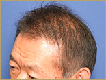 60代男性T.Nさんの頭部写真1（術後5ヶ月）