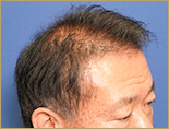 60代男性T.Nさんの頭部写真3（術後5ヶ月）