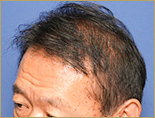 60代男性T.Nさんの頭部写真1（施術後）