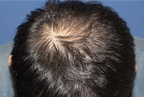 40代 男性 T.Dさん 生え際・頭頂部 自毛植毛（MIRAI法）2,050株の症例（手術後）_01