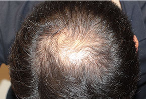 40代 男性 T.Dさん 生え際・頭頂部 自毛植毛（MIRAI法） 2,050株の症例（手術前）_01