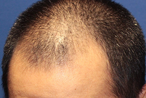20代 男性 T.S.さん 生え際 頭頂部 自毛植毛（MIRAI法） 1,500株の症例（手術前）_01
