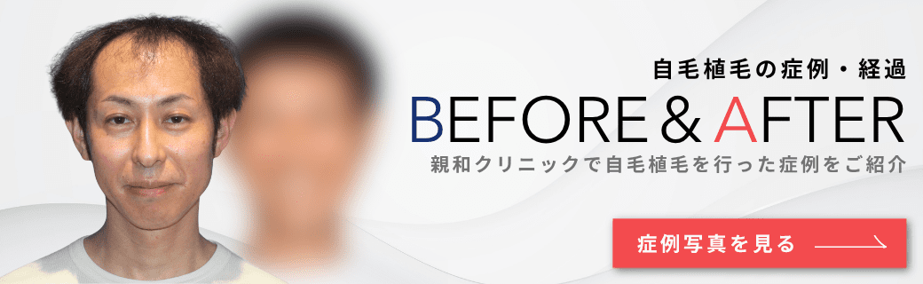 自毛植毛の症例・経過