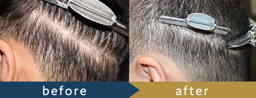 自毛植毛（NC-MIRAI法）400株の施術前症例