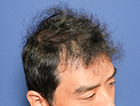 40代男性K.Tさんの頭部写真3（術後5ヶ月）