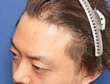 男性M.Yさんの頭部写真1（術後5ヶ月）