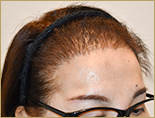 50代 女性 M.Mさんの頭部写真3（施術後）