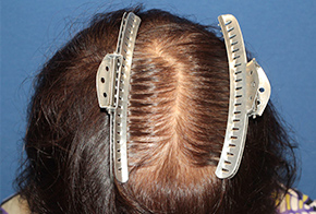 50代 女性 K.S.さん 前頭部・頭頂部 自毛植毛（MIRAI法） 1,200株の症例（手術後）_01