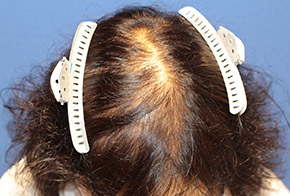 50代 女性 K.S.さん 前頭部・頭頂部 自毛植毛（MIRAI法） 1,200株の症例（手術前）_01