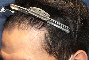 20代 男性 T.S.さん 生え際 頭頂部 自毛植毛（MIRAI法） 1,500株の症例（手術後）_01